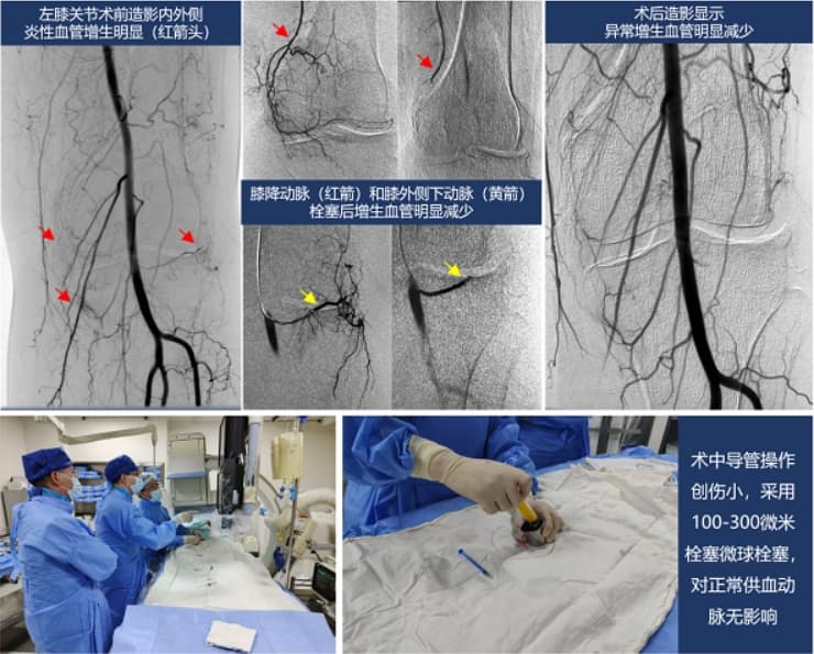 缓解老年性关节疼痛 介入栓塞为骨性关节炎提供治疗新方案