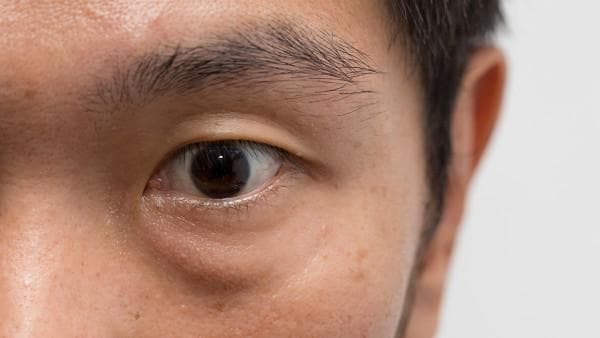 睡前喝水会有眼袋吗