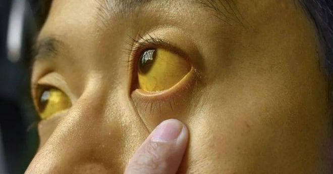 轻视乙肝家族史，病情恶化后果：乙肝患者需做的四件事
