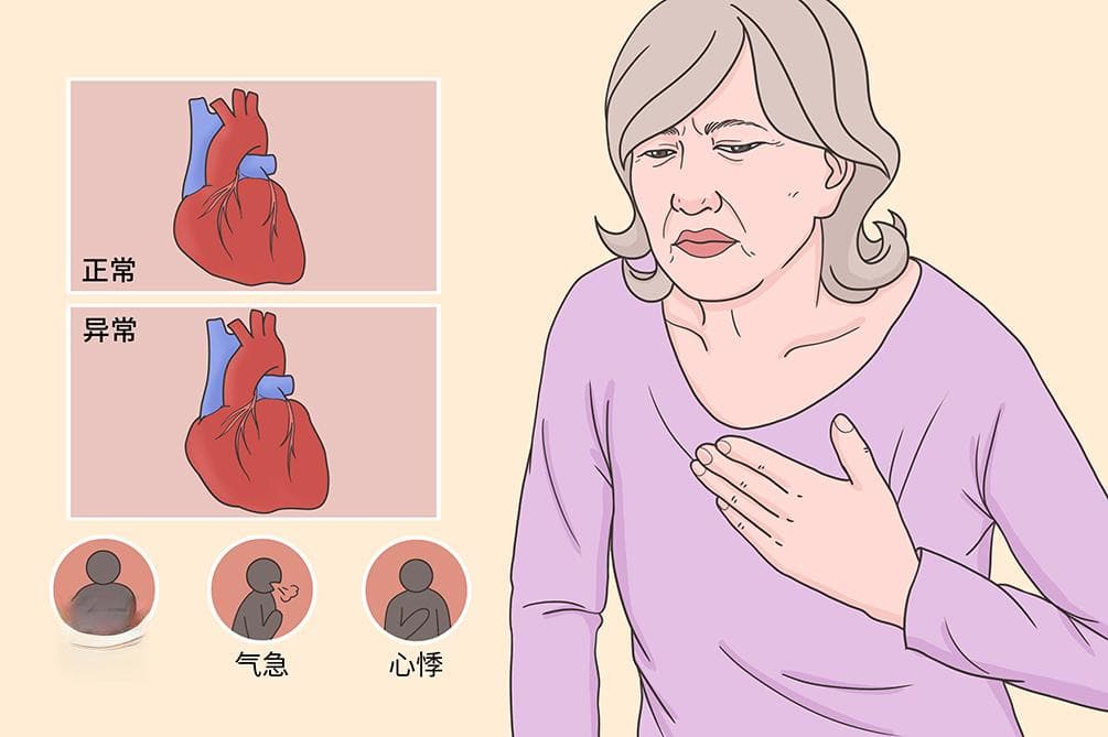 心脏性猝死