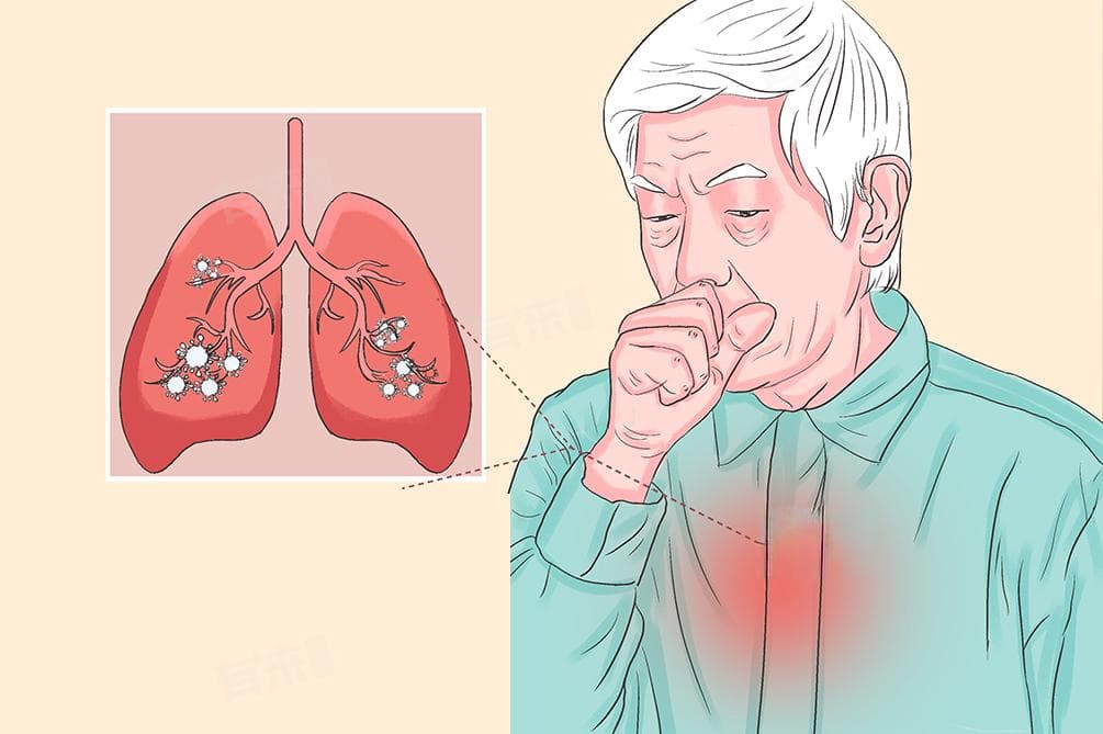 肺内真菌感染：病因、预防及传染性分析