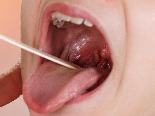 口腔念珠菌病的5种治疗方法