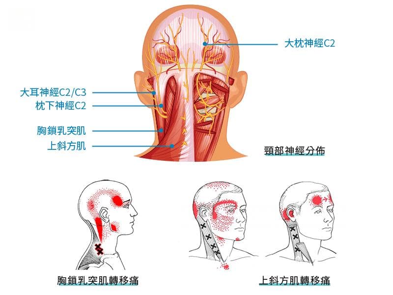 长期头痛、后枕痛找不到原因？颈源性头痛怎么办？