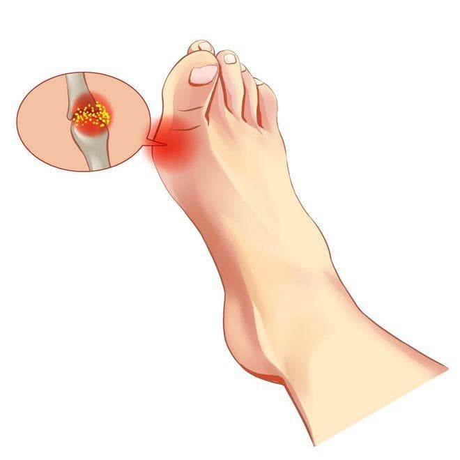 痛风患者要运动，运动又疼该怎么办？痛风专家周桂兰为你支招！