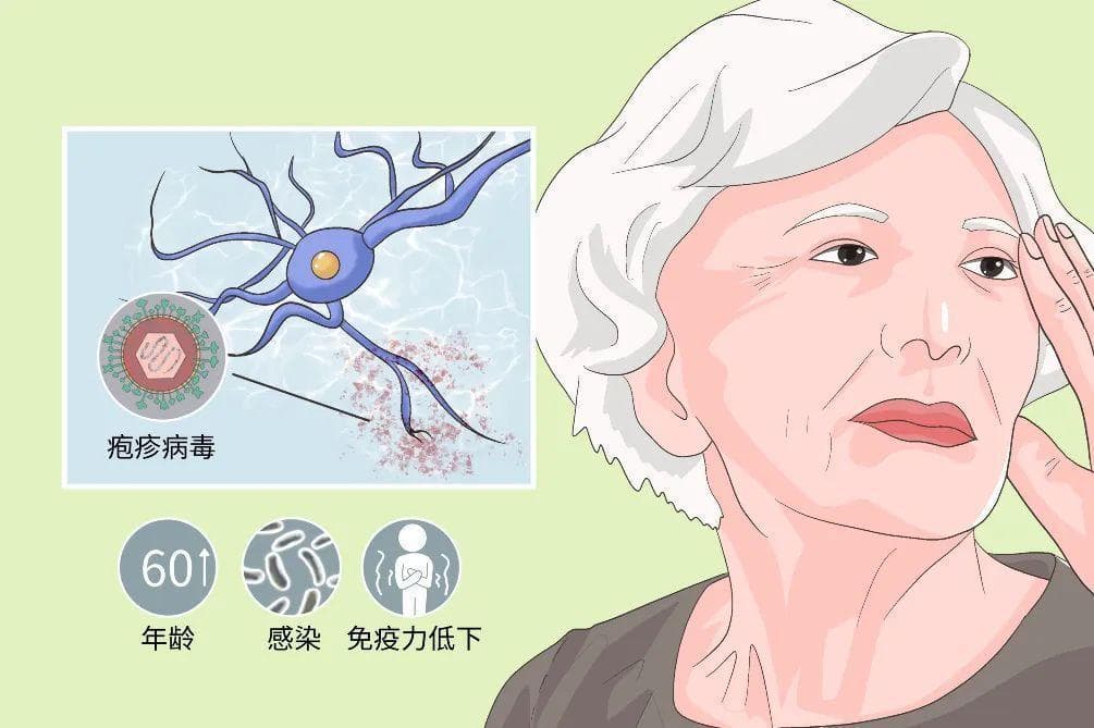 中老年人带状疱疹高发，主动预防远离“切肤之痛”
