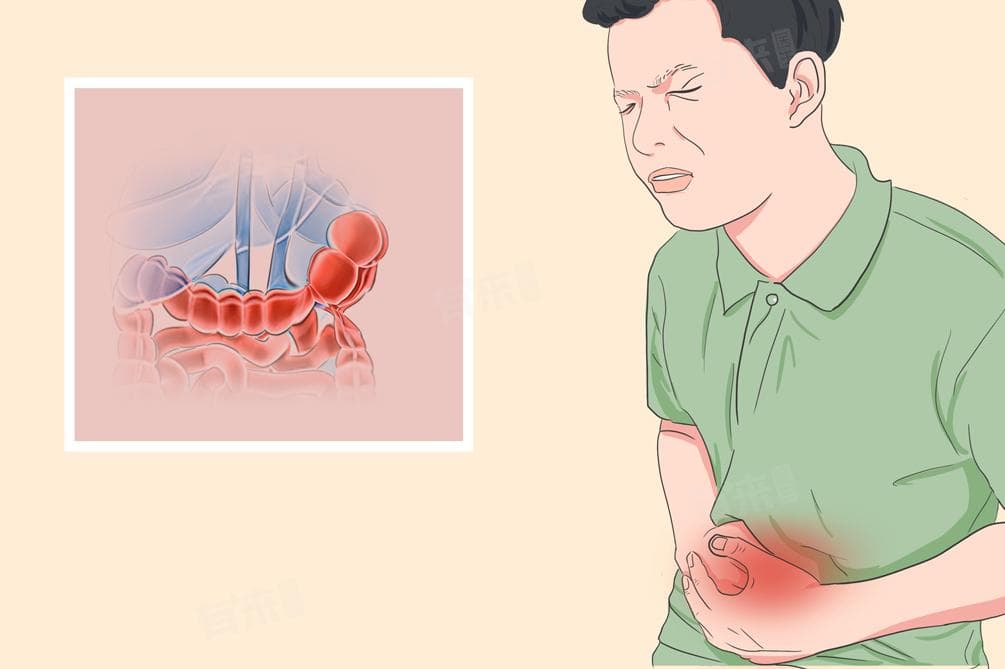 绞窄性肠梗阻：定义、症状、诊断与治疗全解析