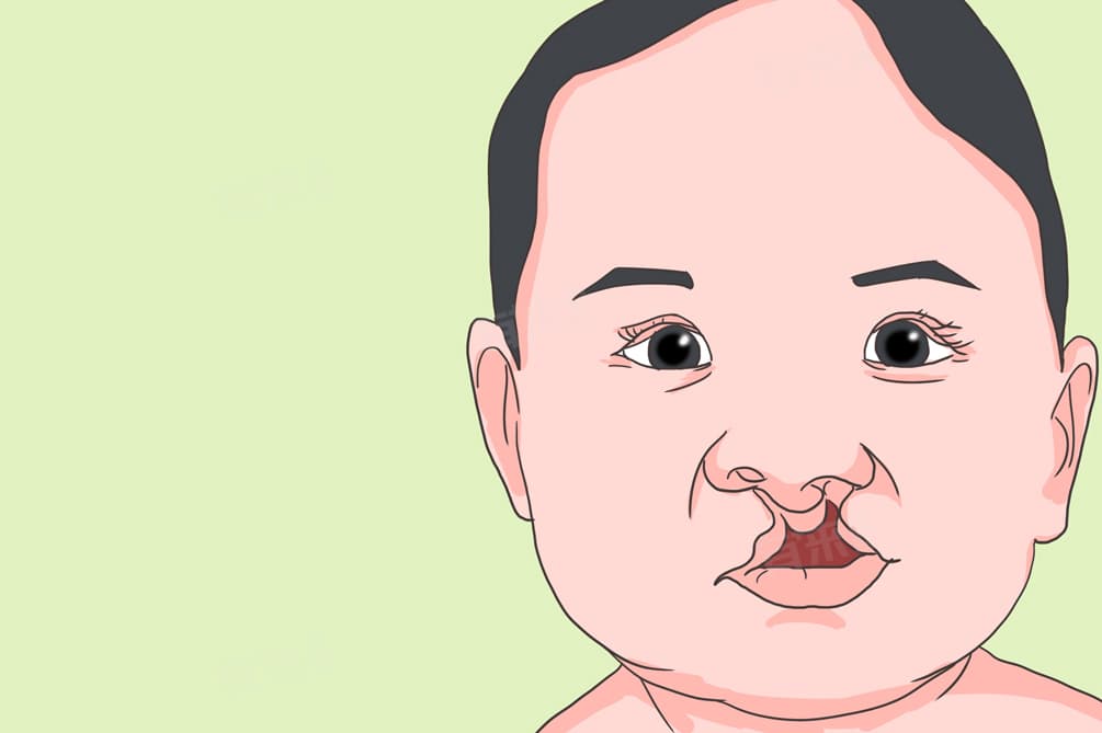 唇腭裂引起的原因