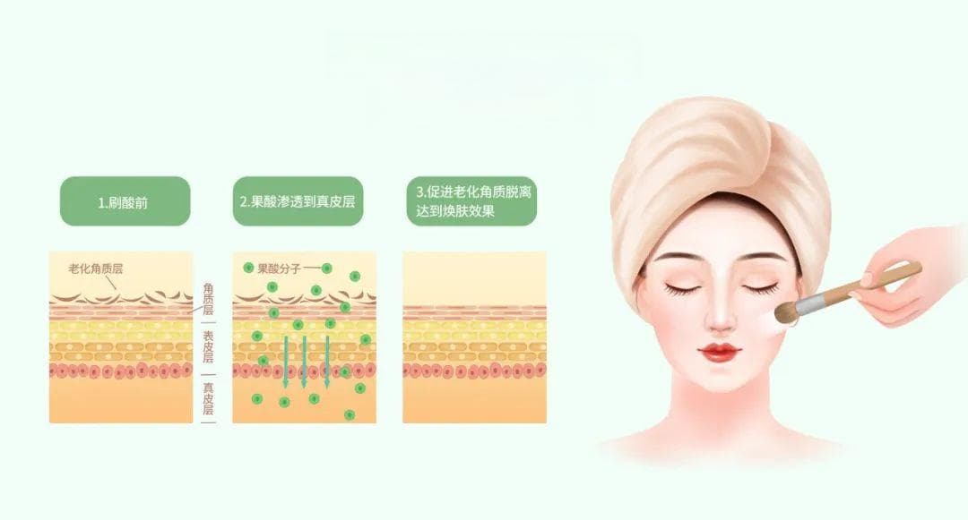 常见医美项目怎么选？果酸换肤、光子嫩肤、水光针、黄金微针