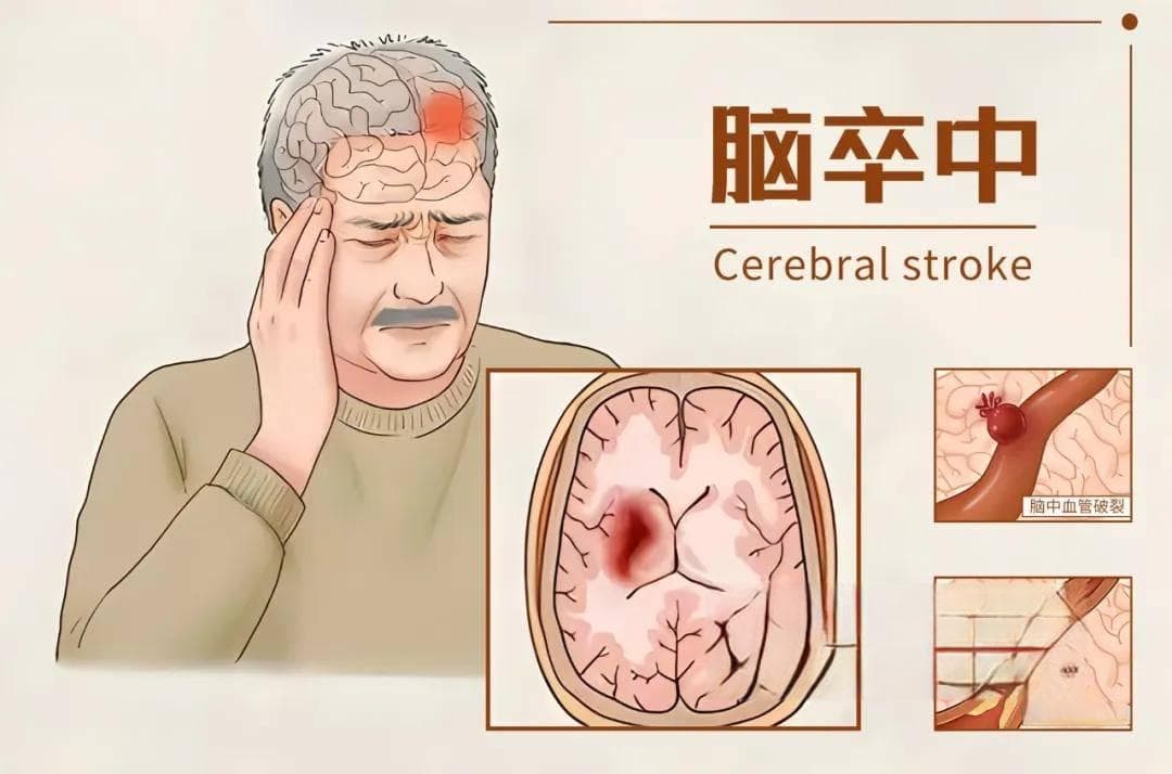中风后的面瘫有哪些治疗方法？耐心和综合治疗方案帮患者重拾笑容