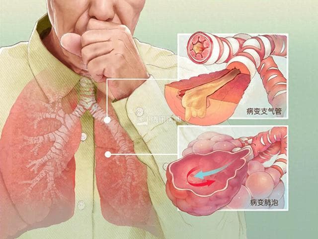 警惕“沉默的杀手”——慢阻肺