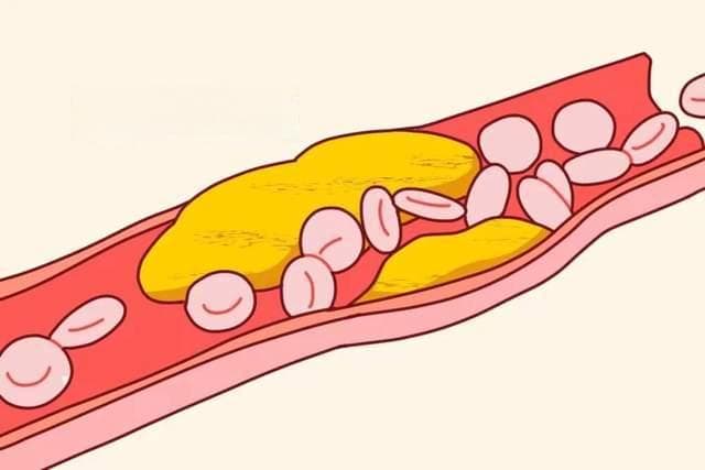 胆固醇有好也有坏？科学管理胆固醇，从生活细节做起