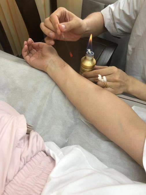 火针技术：开启中风后遗症康复之门的神奇钥匙
