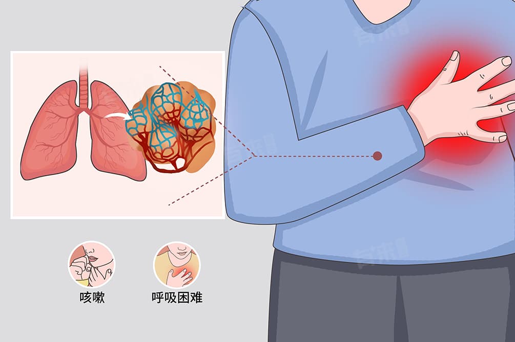 双肺少许纤维增殖灶是什么意思