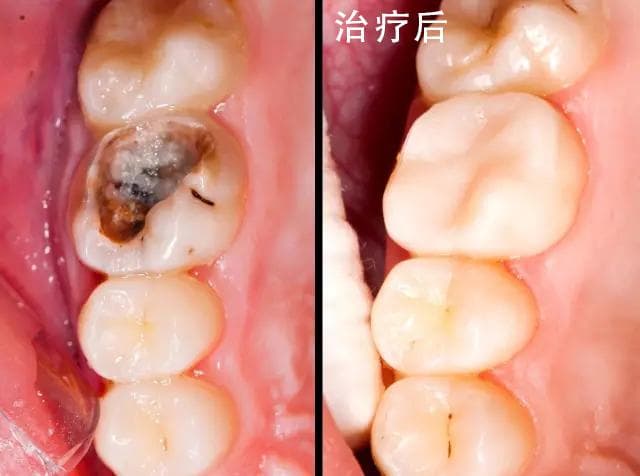 牙疼怎么缓解疼痛,怀孕牙疼怎么缓解疼痛