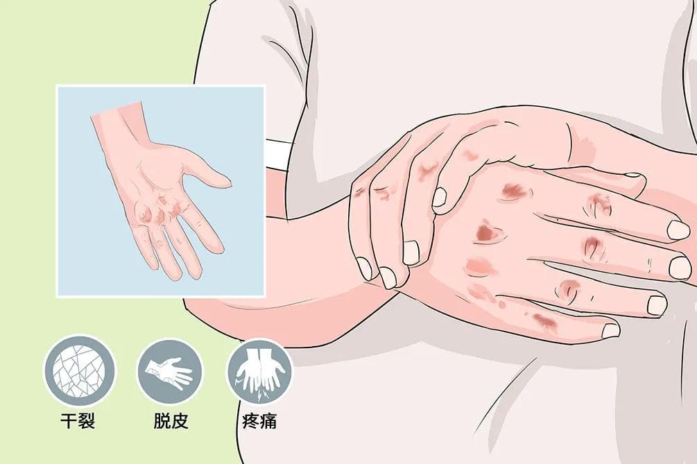 手足皲裂：病因、症状、治疗与预防全解析