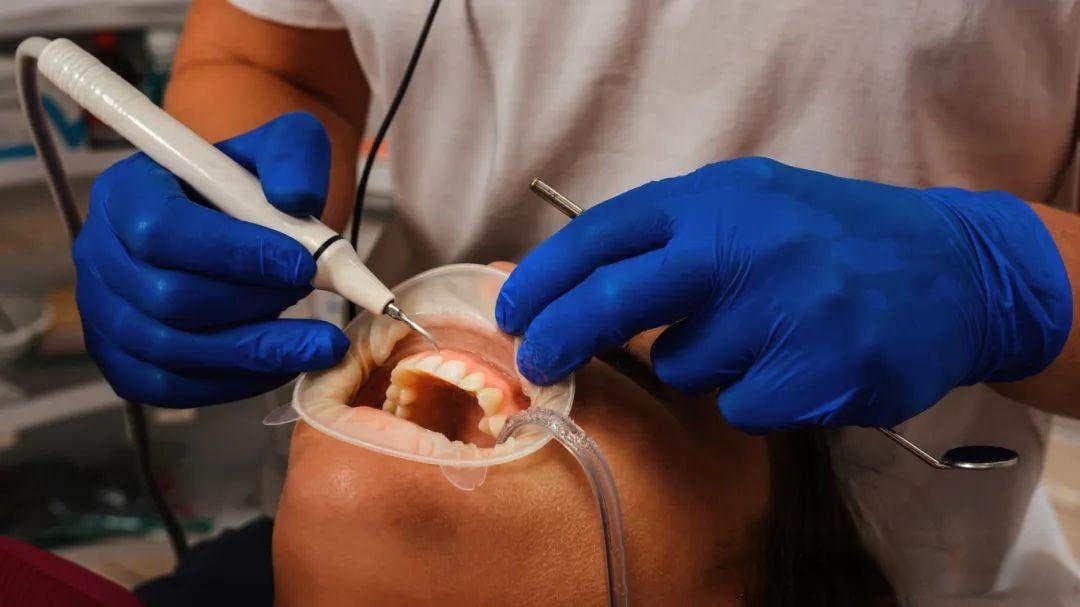 看完这篇 彻底和口腔杀手「牙结石」说再见