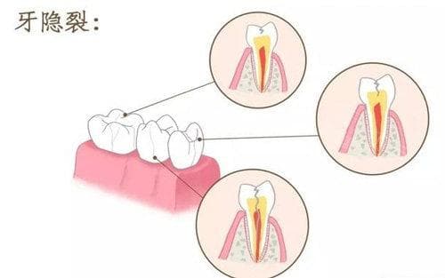 牙齿裂成两半怎么办？多种治疗方案详解
