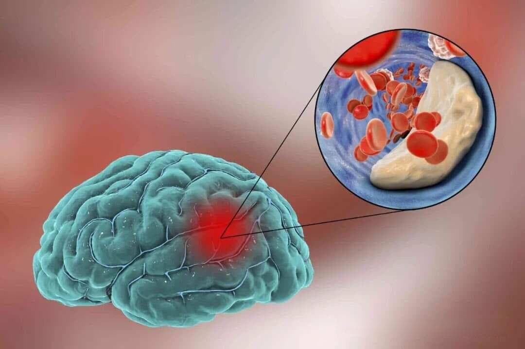 脑梗病根在脾，中医一张好方，让脑梗患者生活自理！