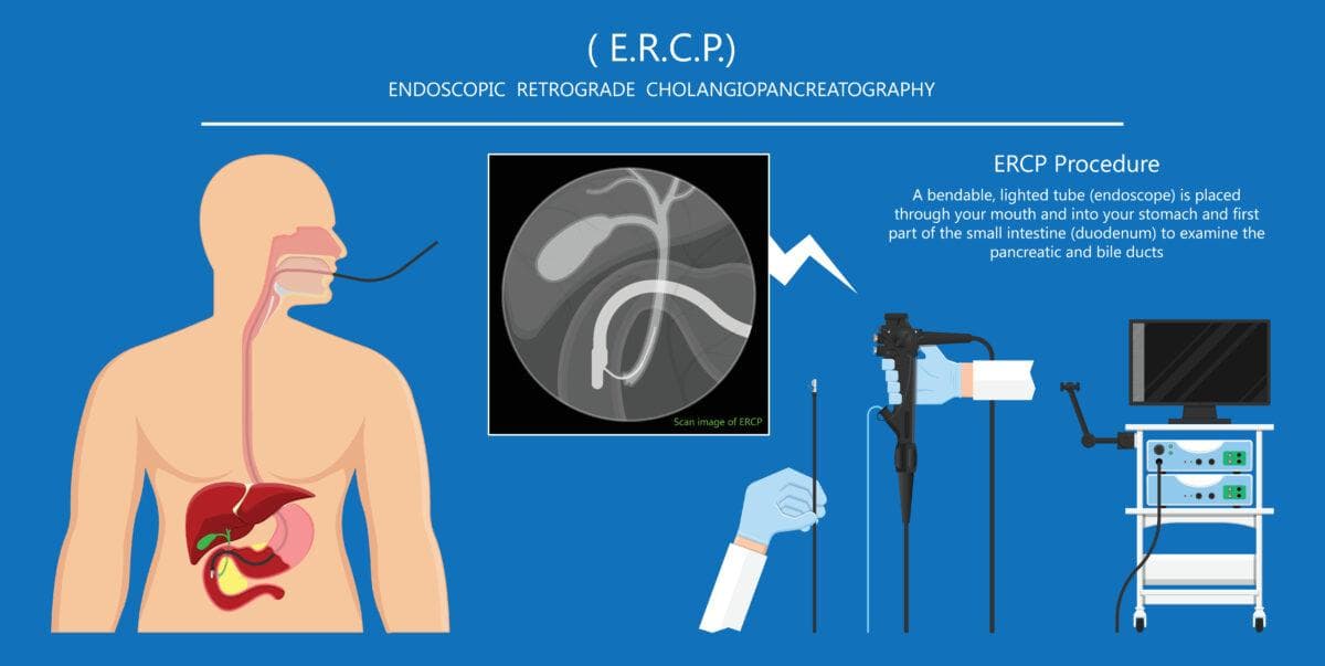 ERCP 内镜检查胆管和胰管