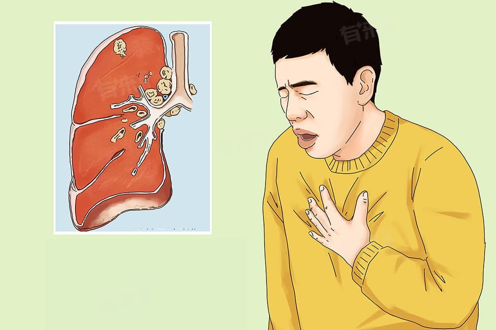 咳嗽腰痛什么原因