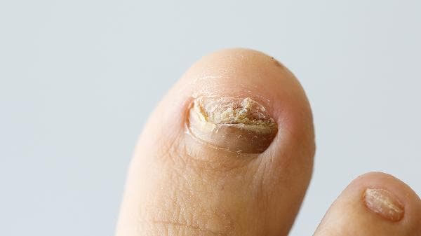 灰指甲治疗方法全解析：从药物到手术，多种方案助力康复