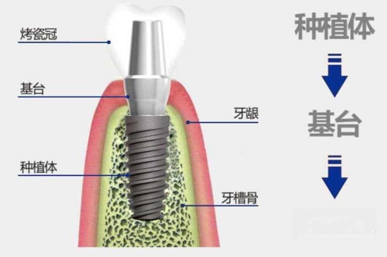 牙齿种植需要哪些条件
