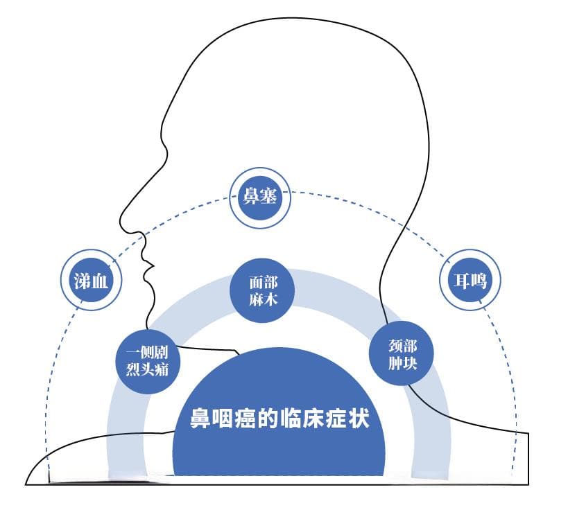 全国肿瘤防治宣传周 | 鼻咽癌的防与治