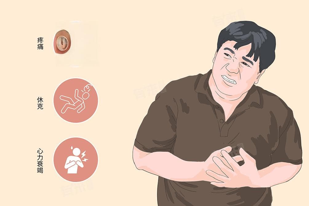 急性心肌梗塞的治疗要点