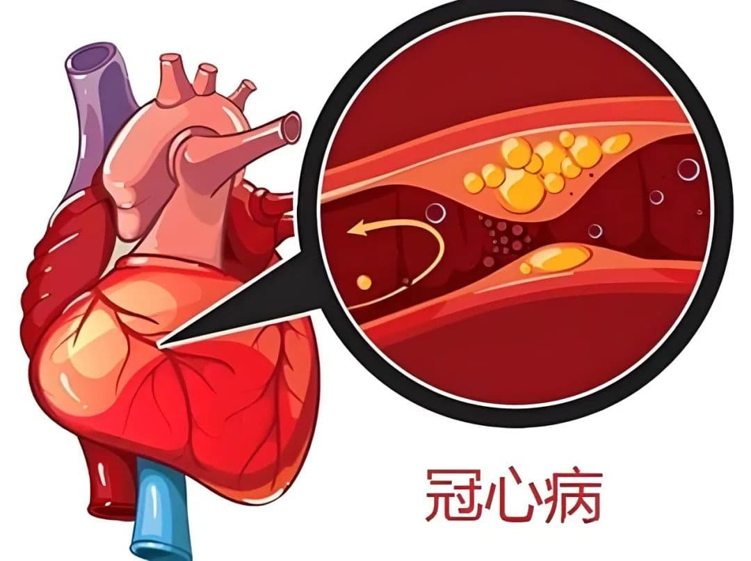 关注冠心病残余风险