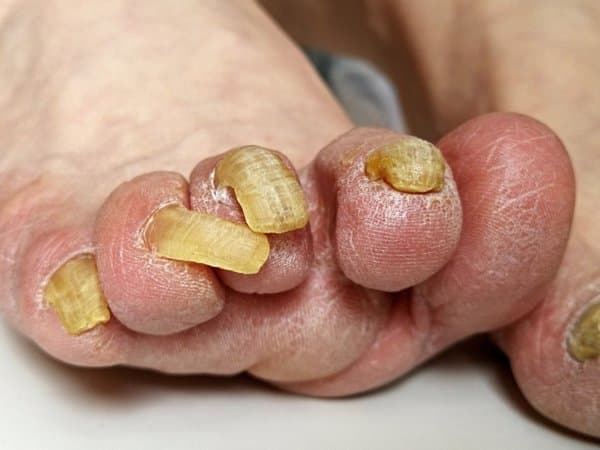 灰指甲出水的原因及治疗建议