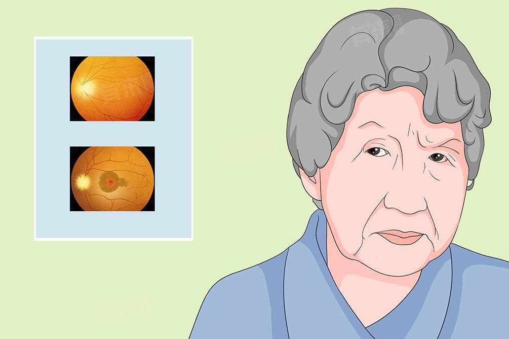 黄斑病变的治疗方法及饮食注意事项
