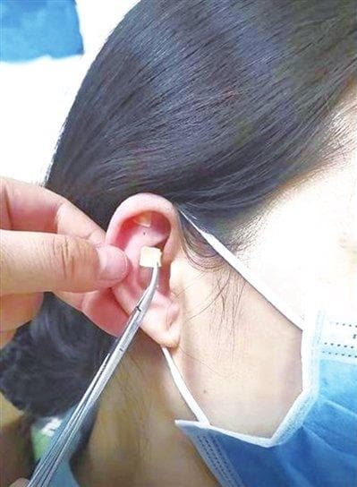 小儿尿频  耳穴压豆可外治