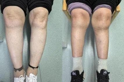 关于X型腿和O型腿的这些知识，你了解吗？