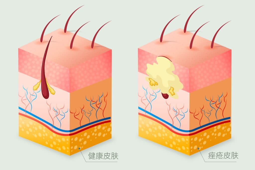 痘痘救星：全面攻略讓您輕松處理頑固痘痘