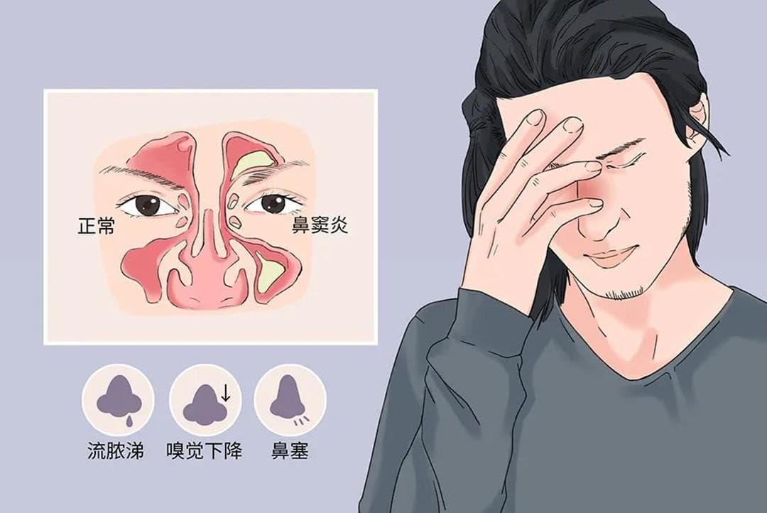 缓解鼻窦疼痛的5个实用方法，这些症状需警惕！