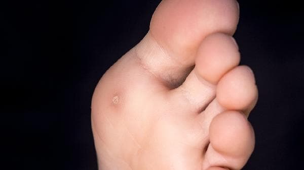 成人扁平足的症状、原因及治疗方法