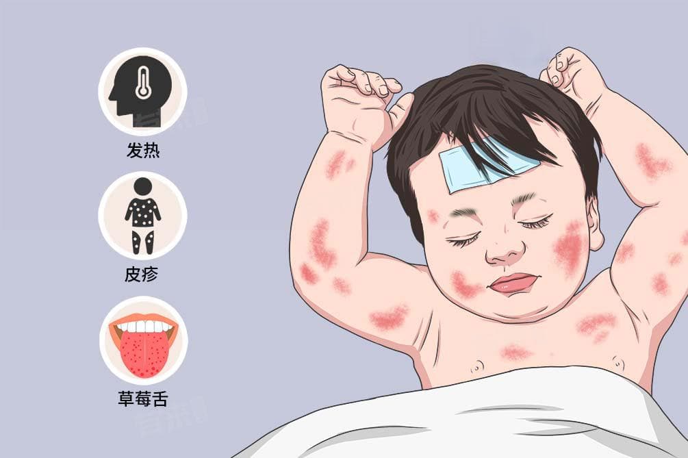 川崎病怎么治疗最有效