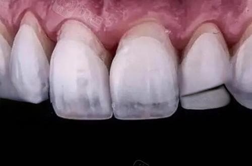 门牙有缝隙怎么解决？快速解决门牙缝隙的4种有效方法，医生教你科学选择！