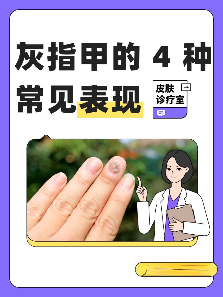 灰指甲不治疗会怎么样？会自己好起来吗？