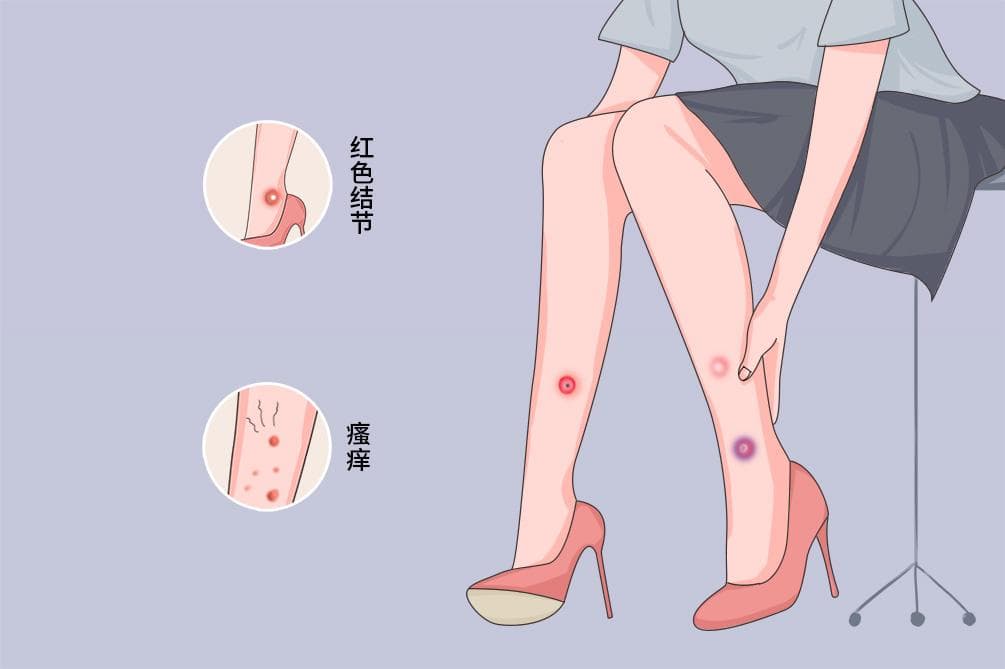 结节性痒疹：症状、治疗和护理全攻略