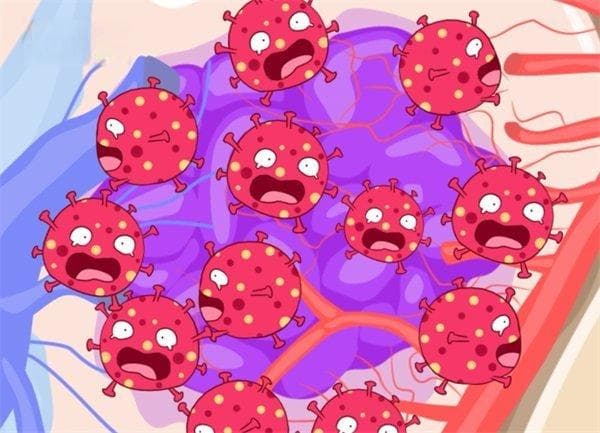 颈内动脉动脉瘤：症状、成因、治疗方法全解析