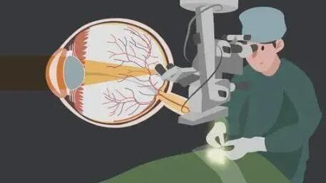 近视眼手术需要多少钱？含项目收费标准详情