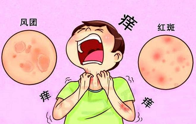 荨麻疹真的能要人命吗？