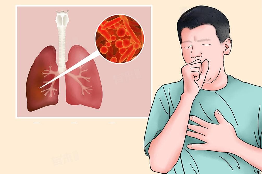 肺炎链球菌感染：症状、诊断与治疗全解析