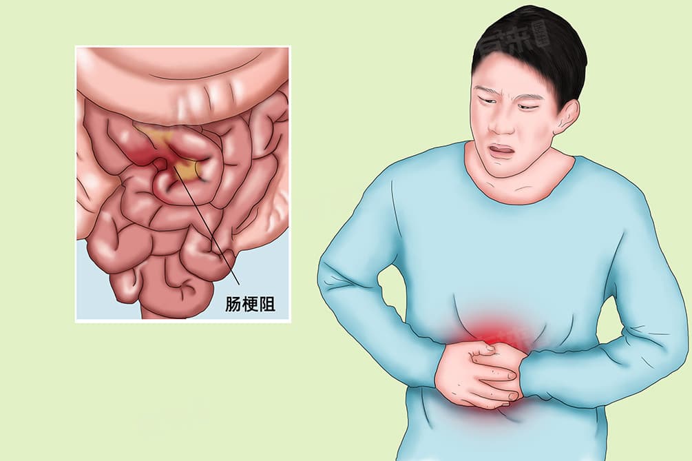 不完全性肠梗阻：病因、治疗与护理全解析