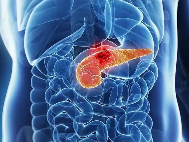 每年新增胰腺癌患者13万例，5年生存率仅7.2%，4类人群做好预防