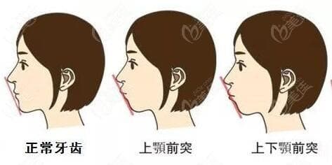 真凸嘴和假凸嘴的区别：23岁牙齿矫正还来得及吗？