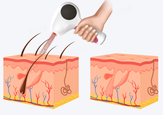 腋下毛发怎么去掉？四种科学方法详解