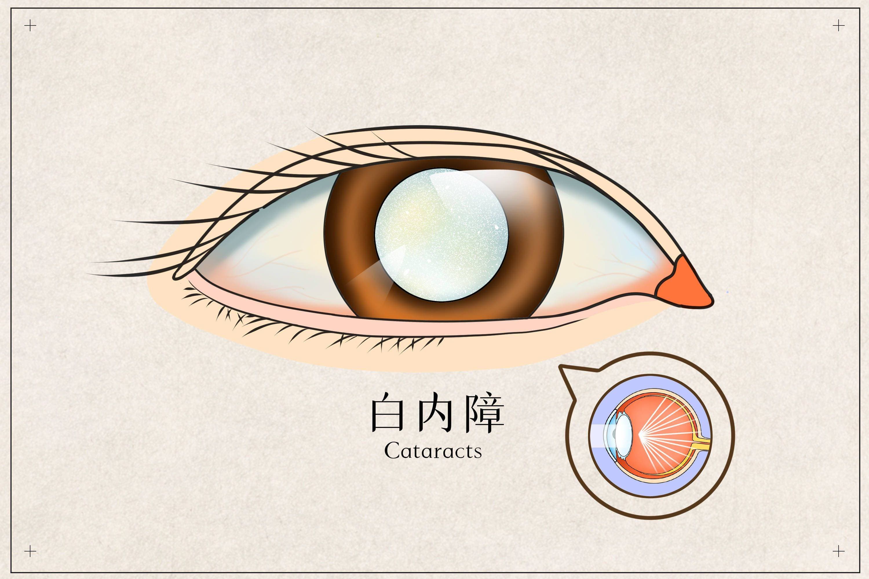 白内障的最佳手术时机？