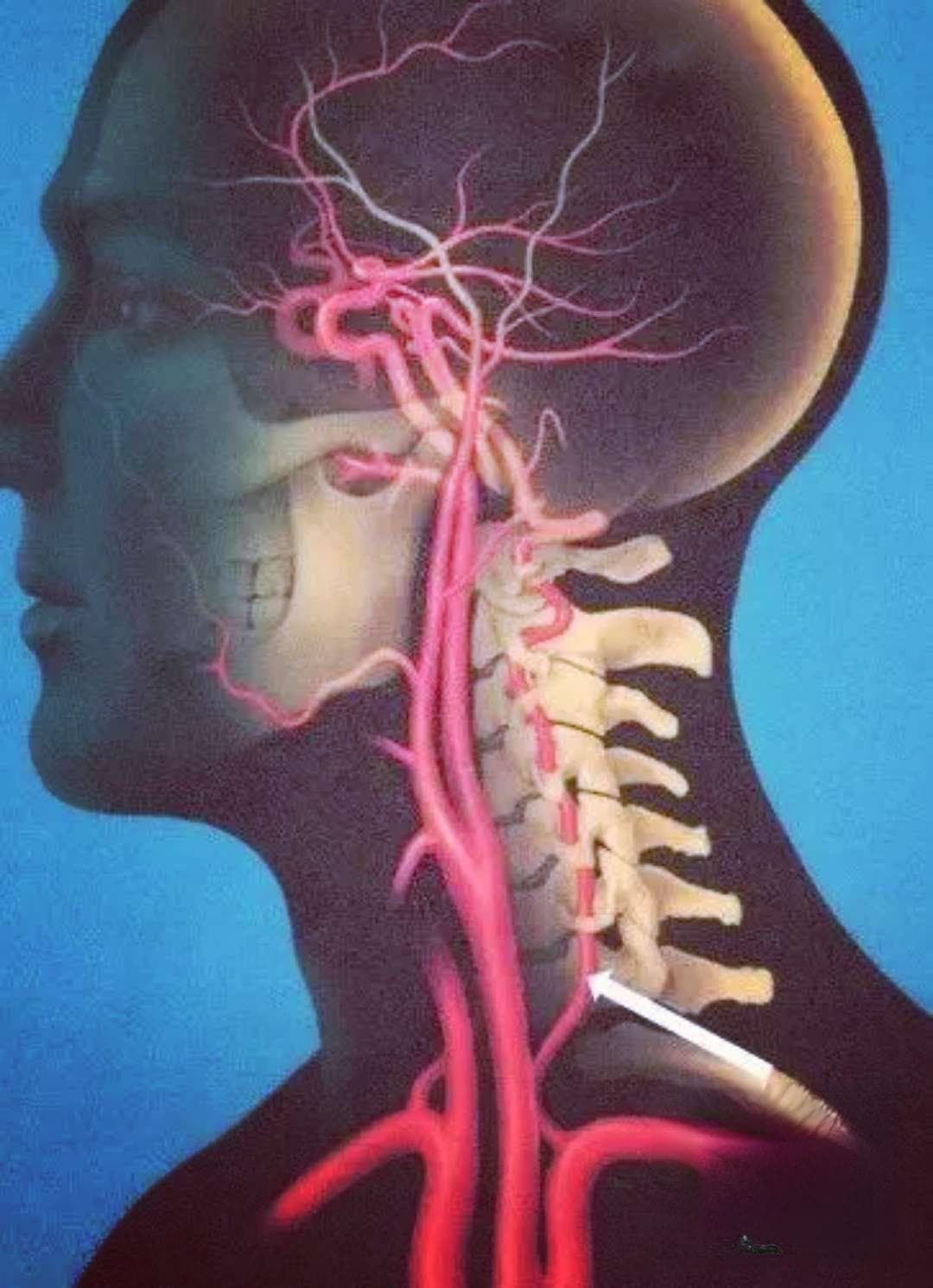 颈椎病引发眩晕？专家解析椎动脉型颈椎病防治要点
